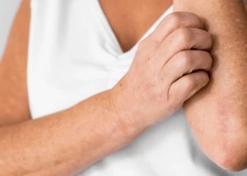 Convocan a taller gratuito en línea el 29 de enero a las 19:00 sobre Dermatitis Atópica, enfermedad que afecta a 1 de cada 10 mexicanos