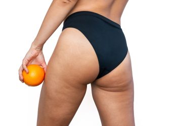 La celulitis se quedó en el pasado: Continúa este inicio de año con un lienzo perfecto