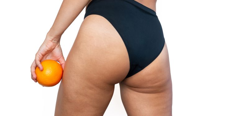 La celulitis se quedó en el pasado: Continúa este inicio de año con un lienzo perfecto