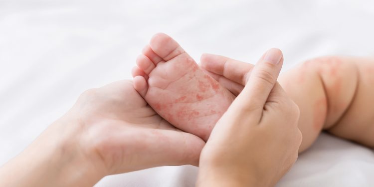 ¡Piel fresca, tu pequeño feliz! Dile adiós a la dermatitis con WaterWipes
