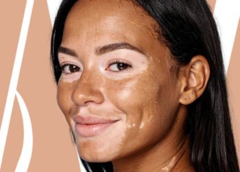 Hablemos de vitiligo