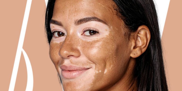 Hablemos de vitiligo