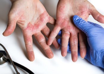 Manos limpias y piel sana: El reto para personas con dermatitis atópica