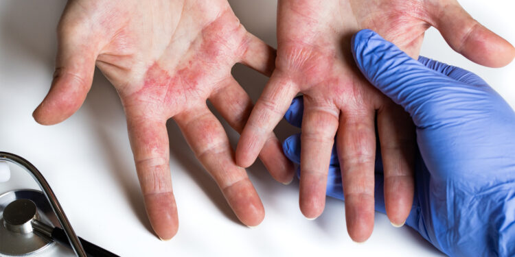 Manos limpias y piel sana: El reto para personas con dermatitis atópica