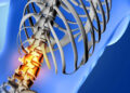 Ocho de cada diez mexicanos enfrenta problemas de columna vertebral: Una crisis de salud silenciosa