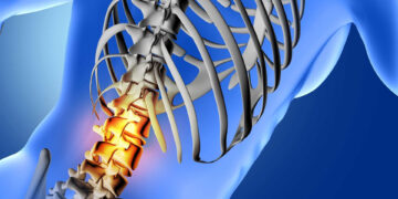 Ocho de cada diez mexicanos enfrenta problemas de columna vertebral: Una crisis de salud silenciosa