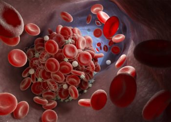 La trombosis, un desafío de salud pública que no discrimina: Llaman a fortalecer la prevención y la atención oportuna en México